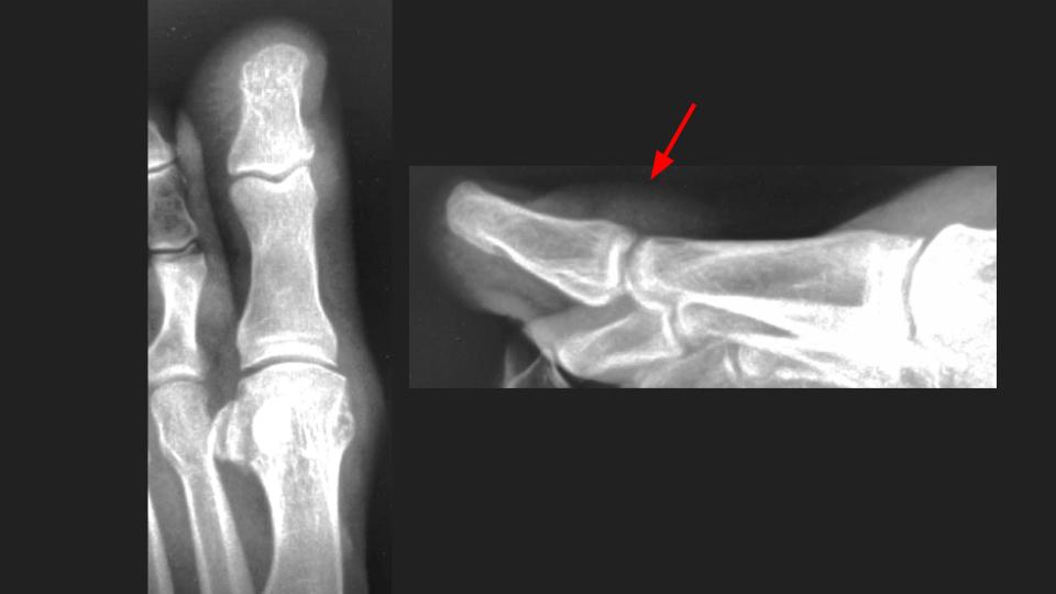 Figure 3 for case infectious or inflammatory disease ( RID3381 )